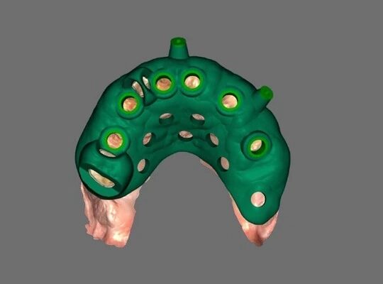 Surgical Guide Design
